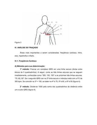 Figura 3: Derivações no plano horizontal
IV. ANÁLISE DO TRAÇADO
Áreas mais importantes a serem consideradas: freqüência cardíaca, ritmo,
eixo, hipertrofia e infarto.
IV.1. Freqüência Cardíaca
A) Métodos para sua determinação:
1º método: Fixa-se um complexo QRS em uma linha escura (divisa entre
blocos de 5 quadradinhos). A seguir, conte as três linhas escuras que se seguem
imediatamente, conhecidas como “300, 150, 100” e as próximas três linhas escuras:
“70, 60, 50”. Se o segundo QRS cair na 2ª linha escura o individuo está com a FC de
300 bpm, Se coincidir na 3ª = 150, se bater na 4ª é 75, 5ª é 60, a 6ª é 50 (figura 4).
2° método: Divide-se 1500 pela soma dos quadradinhos de distância entre
um e outro QRS (figura 4).
V1 V2 V3
V4
V5
V6
 