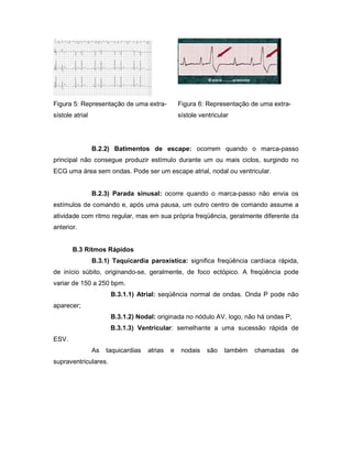 Figura 5: Representação de uma extra-
sístole atrial
Figura 6: Representação de uma extra-
sístole ventricular
B.2.2) Batimentos de escape: ocorrem quando o marca-passo
principal não consegue produzir estímulo durante um ou mais ciclos, surgindo no
ECG uma área sem ondas. Pode ser um escape atrial, nodal ou ventricular.
B.2.3) Parada sinusal: ocorre quando o marca-passo não envia os
estímulos de comando e, após uma pausa, um outro centro de comando assume a
atividade com ritmo regular, mas em sua própria freqüência, geralmente diferente da
anterior.
B.3 Ritmos Rápidos
B.3.1) Taquicardia paroxística: significa freqüência cardíaca rápida,
de início súbito, originando-se, geralmente, de foco ectópico. A freqüência pode
variar de 150 a 250 bpm.
B.3.1.1) Atrial: seqüência normal de ondas. Onda P pode não
aparecer;
B.3.1.2) Nodal: originada no nódulo AV, logo, não há ondas P;
B.3.1.3) Ventricular: semelhante a uma sucessão rápida de
ESV.
As taquicardias atrias e nodais são também chamadas de
supraventriculares.
 