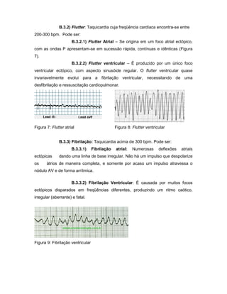 B.3.2) Flutter: Taquicardia cuja freqüência cardíaca encontra-se entre
200-300 bpm. Pode ser:
B.3.2.1) Flutter Atrial – Se origina em um foco atrial ectópico,
com as ondas P apresentam-se em sucessão rápida, contínuas e idênticas (Figura
7).
B.3.2.2) Flutter ventricular – É produzido por um único foco
ventricular ectópico, com aspecto sinusóide regular. O flutter ventricular quase
invariavelmente evolui para a fibrilação ventricular, necessitando de uma
desfibrilação e ressuscitação cardiopulmonar.
Figura 7: Flutter atrial Figura 8: Flutter ventricular
B.3.3) Fibrilação: Taquicardia acima de 300 bpm. Pode ser:
B.3.3.1) Fibrilação atrial: Numerosas deflexões atriais
ectópicas dando uma linha de base irregular. Não há um impulso que despolarize
os átrios de maneira completa, e somente por acaso um impulso atravessa o
nódulo AV e de forma arrítmica.
B.3.3.2) Fibrilação Ventricular: É causada por muitos focos
ectópicos disparados em freqüências diferentes, produzindo um ritmo caótico,
irregular (aberrante) e fatal.
Figura 9: Fibrilação ventricular
 
