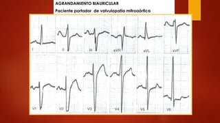 AGRANDAMIENTO BIAURICULAR 
Paciente portador de valvulopatía mitroaórtica 
 