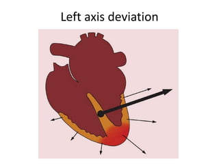Ecg | PPSX