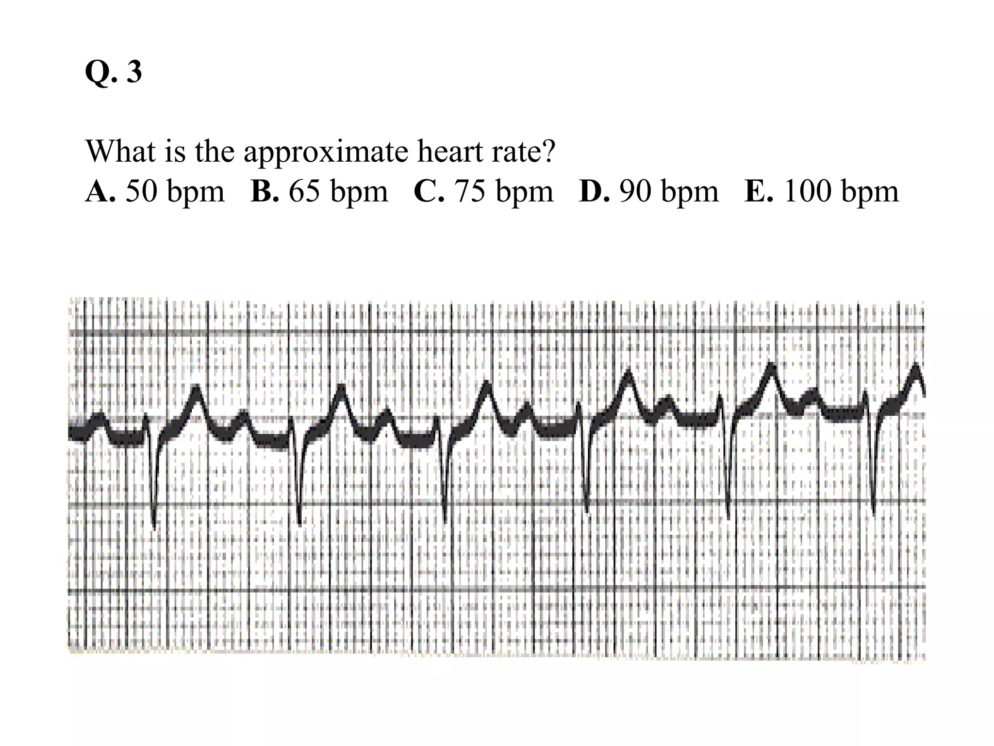 Q. 3
What is the approximate heart rate?
A. 50 bpm B. 65 bpm C. 75 bpm D. 90 bpm E. 100 bpm
 