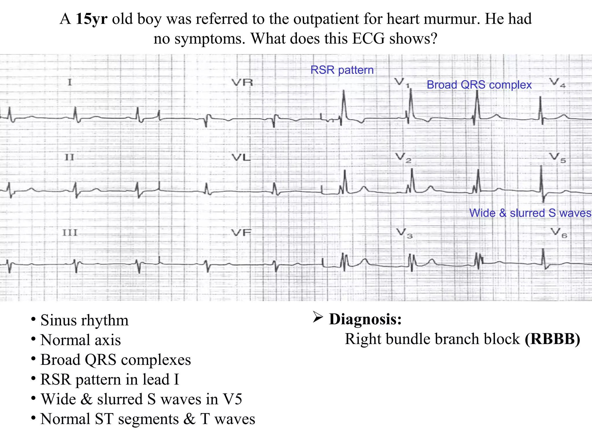 A 15yr old boy was referred to the outpatient for heart murmur. He had
no symptoms. What does this ECG shows?
• Sinus rhythm
• Normal axis
• Broad QRS complexes
• RSR pattern in lead I
• Wide & slurred S waves in V5
• Normal ST segments & T waves
 Diagnosis:
Right bundle branch block (RBBB)
Broad QRS complex
RSR pattern
Wide & slurred S waves
 