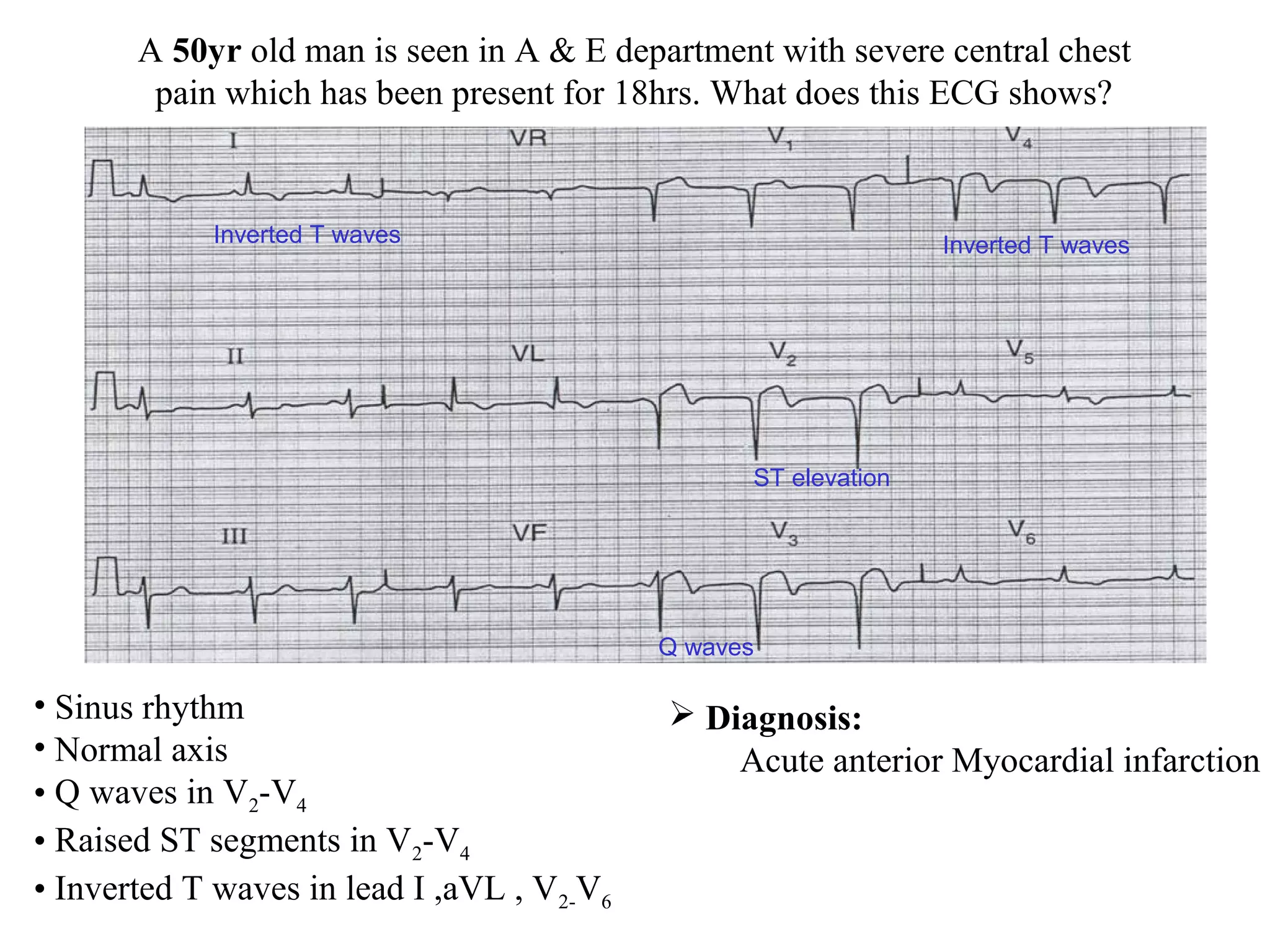 A 50yr old man is seen in A & E department with severe central chest
pain which has been present for 18hrs. What does this ECG shows?
• Sinus rhythm
• Normal axis
• Q waves in V2-V4
• Raised ST segments in V2-V4
• Inverted T waves in lead I ,aVL , V2-V6
 Diagnosis:
Acute anterior Myocardial infarction
ST elevation
Inverted T waves Inverted T waves
Q waves
 