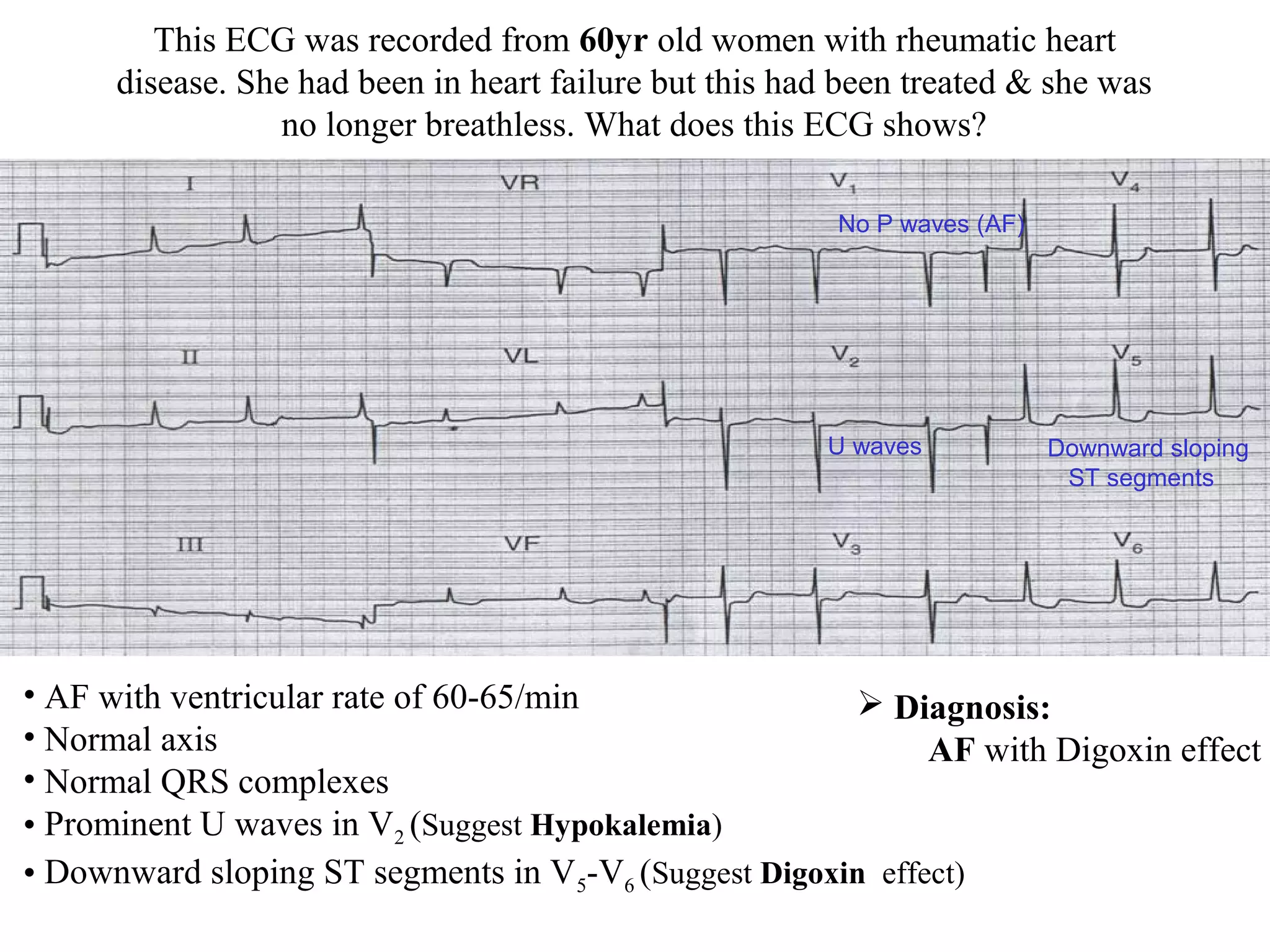 This ECG was recorded from 60yr old women with rheumatic heart
disease. She had been in heart failure but this had been treated & she was
no longer breathless. What does this ECG shows?
• AF with ventricular rate of 60-65/min
• Normal axis
• Normal QRS complexes
• Prominent U waves in V2 (Suggest Hypokalemia)
• Downward sloping ST segments in V5-V6 (Suggest Digoxin effect)
U waves Downward sloping
ST segments
No P waves (AF)
 Diagnosis:
AF with Digoxin effect
 