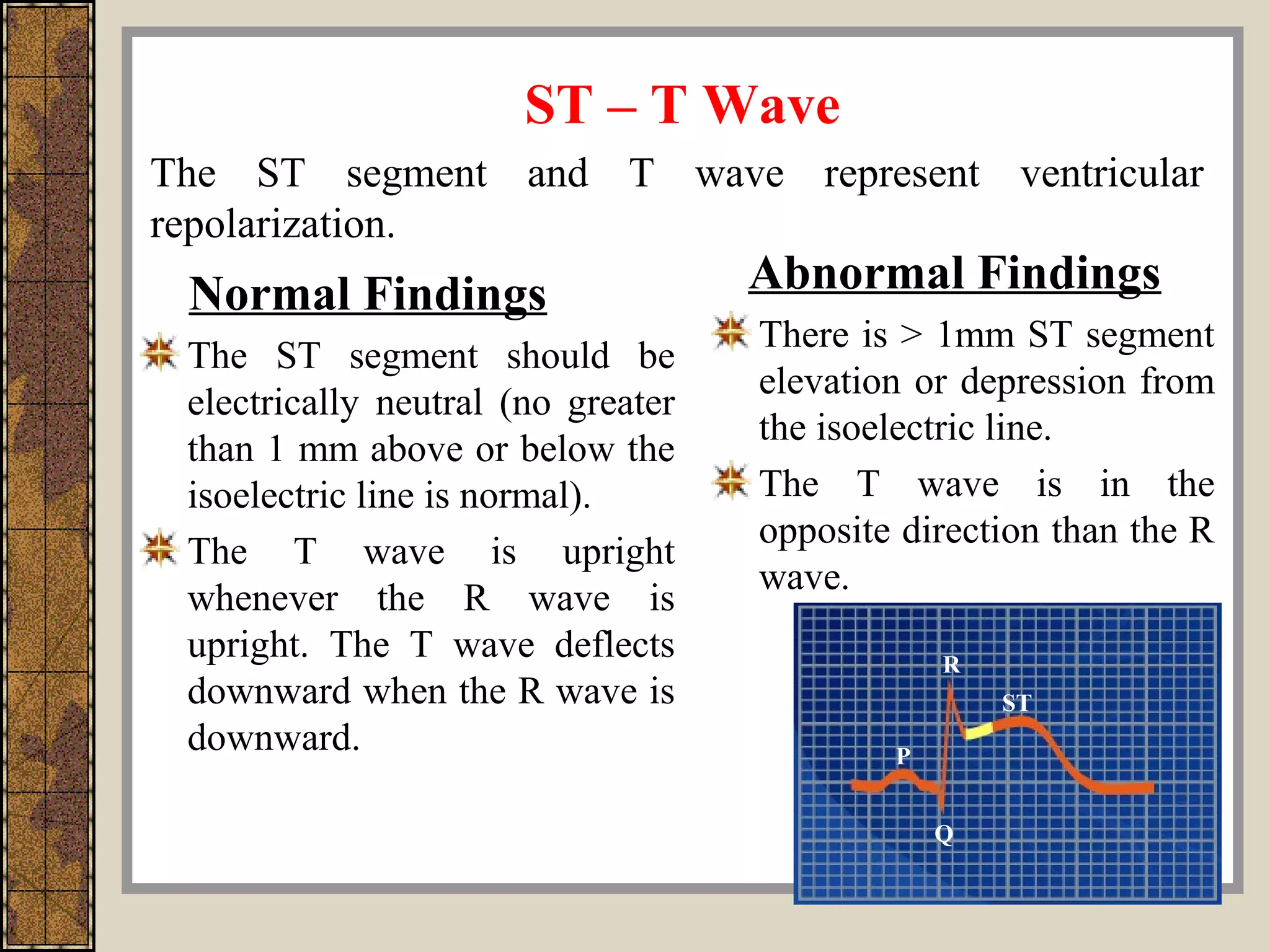 ST – T Wave
Normal Findings
The ST segment should be
electrically neutral (no greater
than 1 mm above or below the
isoelectric line is normal).
The T wave is upright
whenever the R wave is
upright. The T wave deflects
downward when the R wave is
downward.
Abnormal Findings
There is > 1mm ST segment
elevation or depression from
the isoelectric line.
The T wave is in the
opposite direction than the R
wave.
The ST segment and T wave represent ventricular
repolarization.
R
P
Q
ST
 