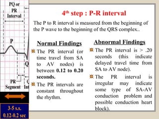 Ecg for Nurses... | PPT