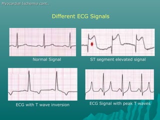 Different ECG Signals
Normal Signal ST segment elevated signal
ECG with T wave inversion ECG Signal with peak T waves
Myocardial Ischemia cont..Myocardial Ischemia cont..
 