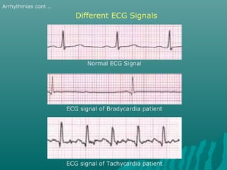 Different ECG Signals
Normal ECG Signal
ECG signal of Bradycardia patient
ECG signal of Tachycardia patient
Arrhythmias cont ..
 
