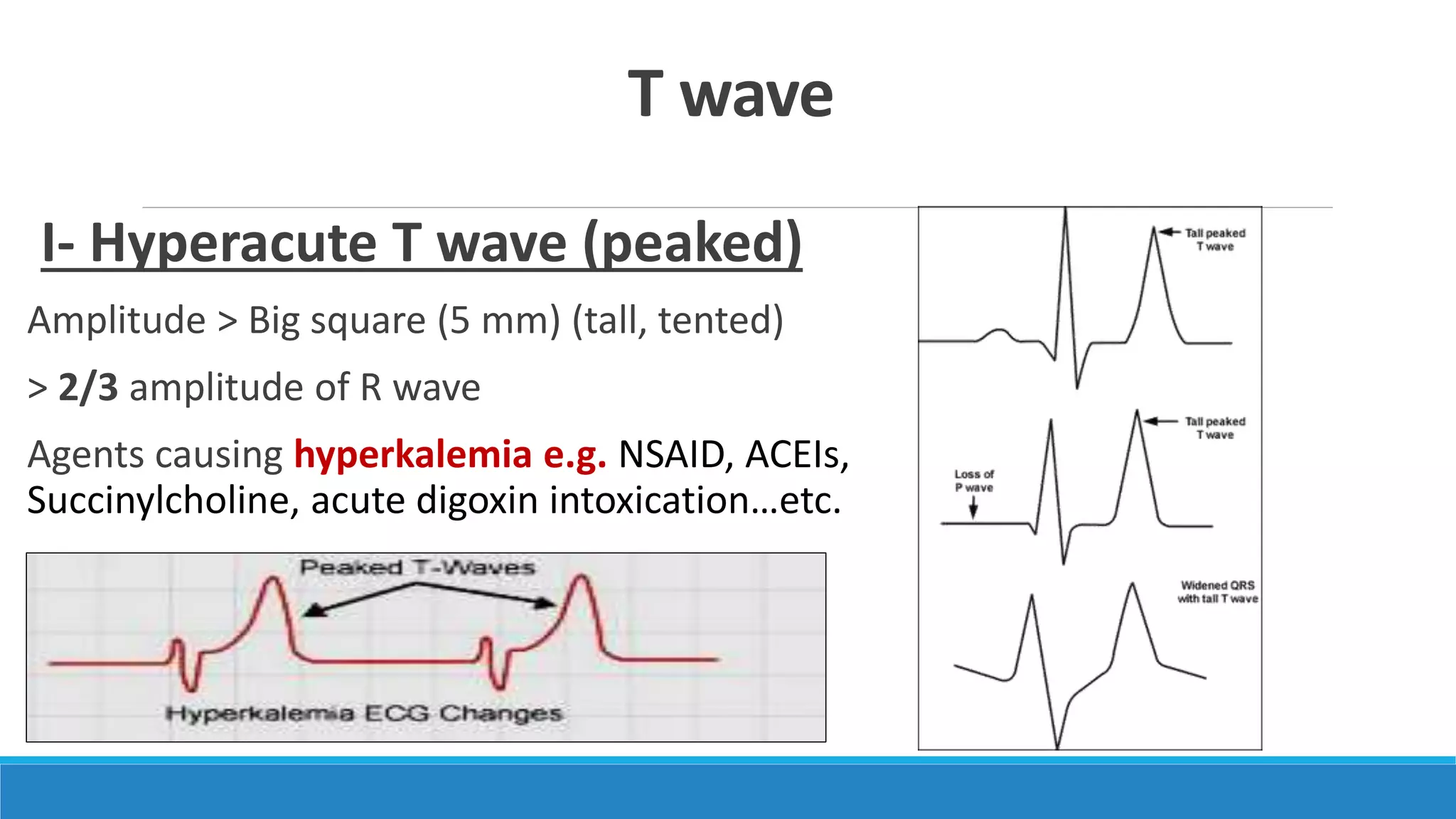 Ecg step by step approach updated pptx