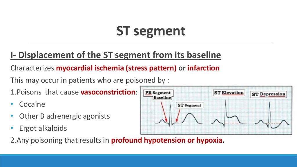 Ecg step by step approach updated 