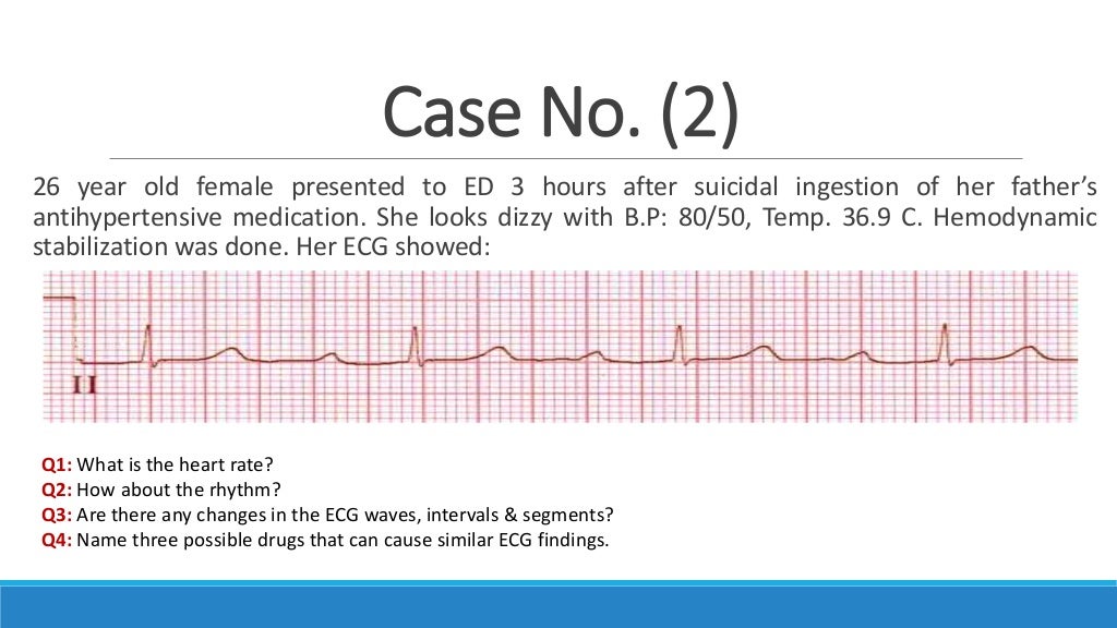 Ecg step by step approach updated 