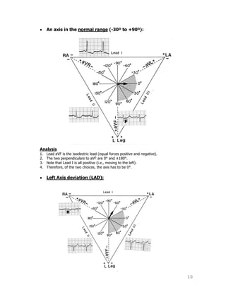 10
An axis in the normal range (-30º to +90º):
Analysis
1. Lead aVF is the isoelectric lead (equal forces positive and negative).
2. The two perpendiculars to aVF are 0° and ±180°.
3. Note that Lead I is all positive (i.e., moving to the left).
4. Therefore, of the two choices, the axis has to be 0°.
Left Axis deviation (LAD):
 