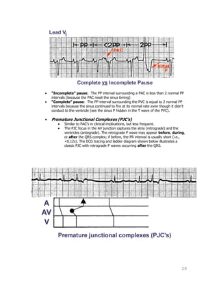 20
“Incomplete” pause: The PP interval surrounding a PAC is less than 2 normal PP
intervals (because the PAC reset the sinus timing)
“Complete” pause: The PP interval surrounding the PVC is equal to 2 normal PP
intervals because the sinus continued to fire at its normal rate even though it didn‟t
conduct to the ventricle (see the sinus P hidden in the T wave of the PVC).
Premature Junctional Complexes (PJC's)
Similar to PAC's in clinical implications, but less frequent.
The PJC focus in the AV junction captures the atria (retrograde) and the
ventricles (antegrade). The retrograde P wave may appear before, during,
or after the QRS complex; if before, the PR interval is usually short (i.e.,
<0.12s). The ECG tracing and ladder diagram shown below illustrates a
classic PJC with retrograde P waves occurring after the QRS.
 
