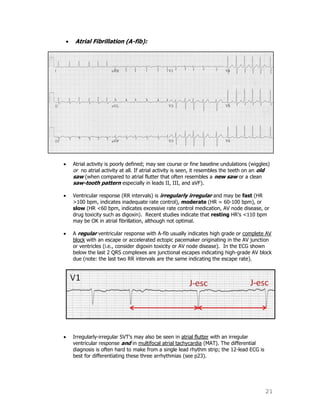 21
Atrial Fibrillation (A-fib):
Atrial activity is poorly defined; may see course or fine baseline undulations (wiggles)
or no atrial activity at all. If atrial activity is seen, it resembles the teeth on an old
saw (when compared to atrial flutter that often resembles a new saw or a clean
saw-tooth pattern especially in leads II, III, and aVF).
Ventricular response (RR intervals) is irregularly irregular and may be fast (HR
>100 bpm, indicates inadequate rate control), moderate (HR = 60-100 bpm), or
slow (HR <60 bpm, indicates excessive rate control medication, AV node disease, or
drug toxicity such as digoxin). Recent studies indicate that resting HR‟s <110 bpm
may be OK in atrial fibrillation, although not optimal.
A regular ventricular response with A-fib usually indicates high grade or complete AV
block with an escape or accelerated ectopic pacemaker originating in the AV junction
or ventricles (i.e., consider digoxin toxicity or AV node disease). In the ECG shown
below the last 2 QRS complexes are junctional escapes indicating high-grade AV block
due (note: the last two RR intervals are the same indicating the escape rate).
Irregularly-irregular SVT‟s may also be seen in atrial flutter with an irregular
ventricular response and in multifocal atrial tachycardia (MAT). The differential
diagnosis is often hard to make from a single lead rhythm strip; the 12-lead ECG is
best for differentiating these three arrhythmias (see p23).
 