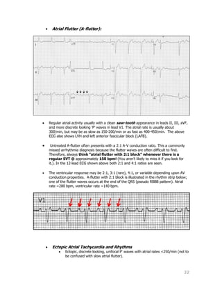 22
Atrial Flutter (A-flutter):
Regular atrial activity usually with a clean saw-tooth appearance in leads II, III, aVF,
and more discrete looking 'P' waves in lead V1. The atrial rate is usually about
300/min, but may be as slow as 150-200/min or as fast as 400-450/min. The above
ECG also shows LVH and left anterior fascicular block (LAFB).
Untreated A-flutter often presents with a 2:1 A-V conduction ratio. This a commonly
missed arrhythmia diagnosis because the flutter waves are often difficult to find.
Therefore, always think "atrial flutter with 2:1 block" whenever there is a
regular SVT @ approximately 150 bpm! (You aren‟t likely to miss it if you look for
it.). In the 12-lead ECG shown above both 2:1 and 4:1 ratios are seen.
The ventricular response may be 2:1, 3:1 (rare), 4:1, or variable depending upon AV
conduction properties. A-flutter with 2:1 block is illustrated in the rhythm strip below;
one of the flutter waves occurs at the end of the QRS (pseudo RBBB pattern). Atrial
rate =280 bpm, ventricular rate =140 bpm.
Ectopic Atrial Tachycardia and Rhythms
Ectopic, discrete looking, unifocal P' waves with atrial rates <250/min (not to
be confused with slow atrial flutter).
 