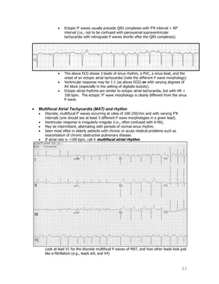23
Ectopic P' waves usually precede QRS complexes with P'R interval < RP'
interval (i.e., not to be confused with paroxysmal supraventricular
tachycardia with retrograde P waves shortly after the QRS complexes).
The above ECG shows 3 beats of sinus rhythm, a PVC, a sinus beat, and the
onset of an ectopic atrial tachycardia (note the different P wave morphology)
Ventricular response may be 1:1 (as above ECG) or with varying degrees of
AV block (especially in the setting of digitalis toxicity).
Ectopic atrial rhythms are similar to ectopic atrial tachycardia, but with HR <
100 bpm. The ectopic „P‟ wave morphology is clearly different from the sinus
P wave.
Multifocal Atrial Tachycardia (MAT) and rhythm
Discrete, multifocal P' waves occurring at rates of 100-250/min and with varying P'R
intervals (one should see at least 3 different P wave morphologies in a given lead).
Ventricular response is irregularly irregular (i.e., often confused with A-fib).
May be intermittent, alternating with periods of normal sinus rhythm.
Seen most often in elderly patients with chronic or acute medical problems such as
exacerbation of chronic obstructive pulmonary disease.
If atrial rate is <100 bpm, call it multifocal atrial rhythm.
Look at lead V1 for the discrete multifocal P waves of MAT, and how other leads look just
like a-fibrillation (e.g., leads aVL and V4)
 