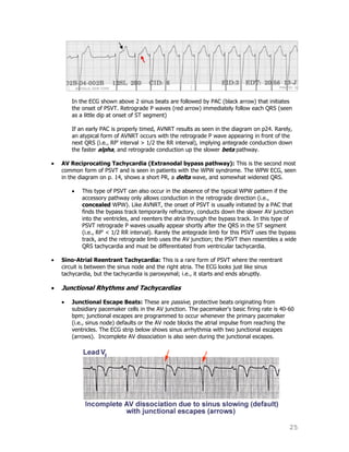 25
In the ECG shown above 2 sinus beats are followed by PAC (black arrow) that initiates
the onset of PSVT. Retrograde P waves (red arrow) immediately follow each QRS (seen
as a little dip at onset of ST segment)
If an early PAC is properly timed, AVNRT results as seen in the diagram on p24. Rarely,
an atypical form of AVNRT occurs with the retrograde P wave appearing in front of the
next QRS (i.e., RP' interval > 1/2 the RR interval), implying antegrade conduction down
the faster alpha, and retrograde conduction up the slower beta pathway.
AV Reciprocating Tachycardia (Extranodal bypass pathway): This is the second most
common form of PSVT and is seen in patients with the WPW syndrome. The WPW ECG, seen
in the diagram on p. 14, shows a short PR, a delta wave, and somewhat widened QRS.
This type of PSVT can also occur in the absence of the typical WPW pattern if the
accessory pathway only allows conduction in the retrograde direction (i.e.,
concealed WPW). Like AVNRT, the onset of PSVT is usually initiated by a PAC that
finds the bypass track temporarily refractory, conducts down the slower AV junction
into the ventricles, and reenters the atria through the bypass track. In this type of
PSVT retrograde P waves usually appear shortly after the QRS in the ST segment
(i.e., RP' < 1/2 RR interval). Rarely the antegrade limb for this PSVT uses the bypass
track, and the retrograde limb uses the AV junction; the PSVT then resembles a wide
QRS tachycardia and must be differentiated from ventricular tachycardia.
Sino-Atrial Reentrant Tachycardia: This is a rare form of PSVT where the reentrant
circuit is between the sinus node and the right atria. The ECG looks just like sinus
tachycardia, but the tachycardia is paroxysmal; i.e., it starts and ends abruptly.
Junctional Rhythms and Tachycardias
Junctional Escape Beats: These are passive, protective beats originating from
subsidiary pacemaker cells in the AV junction. The pacemaker's basic firing rate is 40-60
bpm; junctional escapes are programmed to occur whenever the primary pacemaker
(i.e., sinus node) defaults or the AV node blocks the atrial impulse from reaching the
ventricles. The ECG strip below shows sinus arrhythmia with two junctional escapes
(arrows). Incomplete AV dissociation is also seen during the junctional escapes.
 
