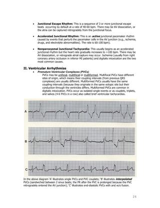26
Junctional Escape Rhythm: This is a sequence of 3 or more junctional escape
beats occurring by default at a rate of 40-60 bpm. There may be AV dissociation, or
the atria can be captured retrogradely from the junctional focus.
Accelerated Junctional Rhythm: This is an active junctional pacemaker rhythm
caused by events that perturb the pacemaker cells in the AV junction (e.g., ischemia,
drugs, and electrolyte abnormalities). The rate is 60-100 bpm).
Nonparoxysmal Junctional Tachycardia: This usually begins as an accelerated
junctional rhythm but the heart rate gradually increases to >100 bpm. There may be
AV dissociation, or retrograde atrial capture may occur. Ischemia (usually from right
coronary artery occlusion in inferior MI patients) and digitalis intoxication are the two
most common causes.
II. Ventricular Arrhythmias
Premature Ventricular Complexes (PVCs)
PVCs may be unifocal, multifocal or multiformed. Multifocal PVCs have different
sites of origin, which means their coupling intervals (from previous QRS
complexes) are usually different. Multiformed PVCs usually have the same
coupling intervals (because they originate in the same ectopic site but their
conduction through the ventricles differs. Multiformed PVCs are common in
digitalis intoxication. PVCs occur as isolated single events or as couplets, triplets,
and salvos (4-6 PVCs in a row) also called brief ventricular tachycardias.
In the above diagram „A‟ illustrates single PVCs and PVC couplets; „B‟ illustrates interpolated
PVCs (sandwiched between 2 sinus beats; the PR after the PVC is prolonged because the PVC
retrogradely entered the AV junction); „C‟ illustrates end-diastolic PVCs with and w/o fusion.
 