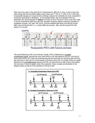 27
PVCs may occur early in the cycle (R-on-T phenomenon), after the T wave, or late in the cycle -
often fusing with the next QRS (called a fusion beat; see 2nd
PVC in „C‟, p26). R-on-T PVCs may
be especially dangerous in acute ischemic settings, because the ventricles are more vulnerable to
ventricular tachycardia or fibrillation. In the example below, late (end-diastolic) PVCs are
illustrated with varying degrees of fusion. For fusion to occur the sinus P wave must have made
it into the ventricles to start the ventricular activation sequence. Before ventricular activation is
completed, however, the "late" PVC occurs, and the resultant QRS looks a bit like the normal
QRS, and a bit like the PVC; i.e., a fusion QRS (see arrows). Also, see the second PVC with
fusion in „C‟ on p26.
The events following a PVC are of interest. Usually a PVC is followed by a complete
compensatory pause, because the sinus node timing is not interrupted by the PVC; one sinus P
wave near the PVC can‟t reach the ventricles because the ventricles are refractory after the PVC;
the next sinus P wave occurs on time based on the basic sinus rate. In contrast, PACs are usually
followed by an incomplete pause because the PAC can reset the sinus node timing; this enables
the next sinus P wave to appear earlier than expected. These concepts are illustrated in the
diagram below as well as in the example on the top of p20.
 
