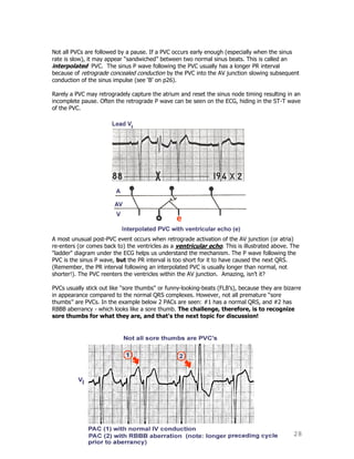 28
Not all PVCs are followed by a pause. If a PVC occurs early enough (especially when the sinus
rate is slow), it may appear “sandwiched” between two normal sinus beats. This is called an
interpolated PVC. The sinus P wave following the PVC usually has a longer PR interval
because of retrograde concealed conduction by the PVC into the AV junction slowing subsequent
conduction of the sinus impulse (see „B‟ on p26).
Rarely a PVC may retrogradely capture the atrium and reset the sinus node timing resulting in an
incomplete pause. Often the retrograde P wave can be seen on the ECG, hiding in the ST-T wave
of the PVC.
A most unusual post-PVC event occurs when retrograde activation of the AV junction (or atria)
re-enters (or comes back to) the ventricles as a ventricular echo. This is illustrated above. The
"ladder" diagram under the ECG helps us understand the mechanism. The P wave following the
PVC is the sinus P wave, but the PR interval is too short for it to have caused the next QRS.
(Remember, the PR interval following an interpolated PVC is usually longer than normal, not
shorter!). The PVC reenters the ventricles within the AV junction. Amazing, isn‟t it?
PVCs usually stick out like "sore thumbs" or funny-looking-beats (FLB‟s), because they are bizarre
in appearance compared to the normal QRS complexes. However, not all premature “sore
thumbs” are PVCs. In the example below 2 PACs are seen: #1 has a normal QRS, and #2 has
RBBB aberrancy - which looks like a sore thumb. The challenge, therefore, is to recognize
sore thumbs for what they are, and that's the next topic for discussion!
 