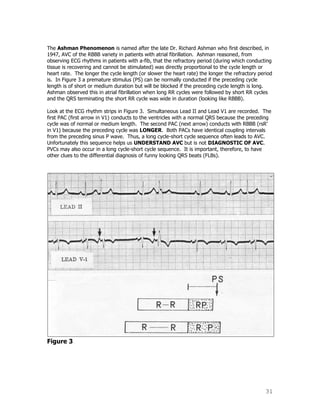 31
The Ashman Phenomenon is named after the late Dr. Richard Ashman who first described, in
1947, AVC of the RBBB variety in patients with atrial fibrillation. Ashman reasoned, from
observing ECG rhythms in patients with a-fib, that the refractory period (during which conducting
tissue is recovering and cannot be stimulated) was directly proportional to the cycle length or
heart rate. The longer the cycle length (or slower the heart rate) the longer the refractory period
is. In Figure 3 a premature stimulus (PS) can be normally conducted if the preceding cycle
length is of short or medium duration but will be blocked if the preceding cycle length is long.
Ashman observed this in atrial fibrillation when long RR cycles were followed by short RR cycles
and the QRS terminating the short RR cycle was wide in duration (looking like RBBB).
Look at the ECG rhythm strips in Figure 3. Simultaneous Lead II and Lead V1 are recorded. The
first PAC (first arrow in V1) conducts to the ventricles with a normal QRS because the preceding
cycle was of normal or medium length. The second PAC (next arrow) conducts with RBBB (rsR‟
in V1) because the preceding cycle was LONGER. Both PACs have identical coupling intervals
from the preceding sinus P wave. Thus, a long cycle-short cycle sequence often leads to AVC.
Unfortunately this sequence helps us UNDERSTAND AVC but is not DIAGNOSTIC OF AVC.
PVCs may also occur in a long cycle-short cycle sequence. It is important, therefore, to have
other clues to the differential diagnosis of funny looking QRS beats (FLBs).
Figure 3
 