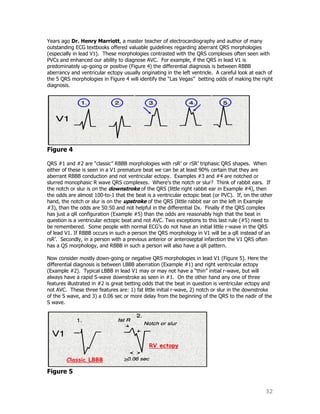 32
Years ago Dr. Henry Marriott, a master teacher of electrocardiography and author of many
outstanding ECG textbooks offered valuable guidelines regarding aberrant QRS morphologies
(especially in lead V1). These morphologies contrasted with the QRS complexes often seen with
PVCs and enhanced our ability to diagnose AVC. For example, if the QRS in lead V1 is
predominately up-going or positive (Figure 4) the differential diagnosis is between RBBB
aberrancy and ventricular ectopy usually originating in the left ventricle. A careful look at each of
the 5 QRS morphologies in Figure 4 will identify the “Las Vegas” betting odds of making the right
diagnosis.
Figure 4
QRS #1 and #2 are “classic” RBBB morphologies with rsR‟ or rSR‟ triphasic QRS shapes. When
either of these is seen in a V1 premature beat we can be at least 90% certain that they are
aberrant RBBB conduction and not ventricular ectopy. Examples #3 and #4 are notched or
slurred monophasic R wave QRS complexes. Where‟s the notch or slur? Think of rabbit ears. If
the notch or slur is on the downstroke of the QRS (little right rabbit ear in Example #4), then
the odds are almost 100-to-1 that the beat is a ventricular ectopic beat (or PVC). If, on the other
hand, the notch or slur is on the upstroke of the QRS (little rabbit ear on the left in Example
#3), than the odds are 50:50 and not helpful in the differential Dx. Finally if the QRS complex
has just a qR configuration (Example #5) than the odds are reasonably high that the beat in
question is a ventricular ectopic beat and not AVC. Two exceptions to this last rule (#5) need to
be remembered. Some people with normal ECG‟s do not have an initial little r-wave in the QRS
of lead V1. If RBBB occurs in such a person the QRS morphology in V1 will be a qR instead of an
rsR‟. Secondly, in a person with a previous anterior or anteroseptal infarction the V1 QRS often
has a QS morphology, and RBBB in such a person will also have a qR pattern.
Now consider mostly down-going or negative QRS morphologies in lead V1 (Figure 5). Here the
differential diagnosis is between LBBB aberration (Example #1) and right ventricular ectopy
(Example #2). Typical LBBB in lead V1 may or may not have a “thin” initial r-wave, but will
always have a rapid S-wave downstroke as seen in #1. On the other hand any one of three
features illustrated in #2 is great betting odds that the beat in question is ventricular ectopy and
not AVC. These three features are: 1) fat little initial r-wave, 2) notch or slur in the downstroke
of the S wave, and 3) a 0.06 sec or more delay from the beginning of the QRS to the nadir of the
S wave.
Figure 5
 