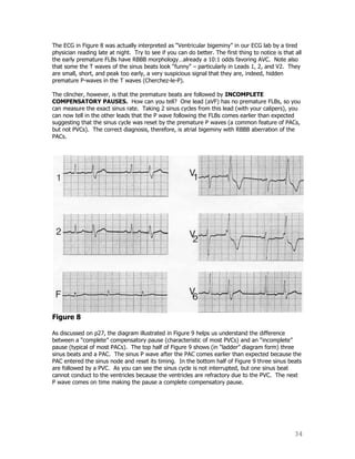 34
The ECG in Figure 8 was actually interpreted as “Ventricular bigeminy” in our ECG lab by a tired
physician reading late at night. Try to see if you can do better. The first thing to notice is that all
the early premature FLBs have RBBB morphology…already a 10:1 odds favoring AVC. Note also
that some the T waves of the sinus beats look “funny” – particularly in Leads 1, 2, and V2. They
are small, short, and peak too early, a very suspicious signal that they are, indeed, hidden
premature P-waves in the T waves (Cherchez-le-P).
The clincher, however, is that the premature beats are followed by INCOMPLETE
COMPENSATORY PAUSES. How can you tell? One lead (aVF) has no premature FLBs, so you
can measure the exact sinus rate. Taking 2 sinus cycles from this lead (with your calipers), you
can now tell in the other leads that the P wave following the FLBs comes earlier than expected
suggesting that the sinus cycle was reset by the premature P waves (a common feature of PACs,
but not PVCs). The correct diagnosis, therefore, is atrial bigeminy with RBBB aberration of the
PACs.
Figure 8
As discussed on p27, the diagram illustrated in Figure 9 helps us understand the difference
between a “complete” compensatory pause (characteristic of most PVCs) and an “incomplete”
pause (typical of most PACs). The top half of Figure 9 shows (in “ladder” diagram form) three
sinus beats and a PAC. The sinus P wave after the PAC comes earlier than expected because the
PAC entered the sinus node and reset its timing. In the bottom half of Figure 9 three sinus beats
are followed by a PVC. As you can see the sinus cycle is not interrupted, but one sinus beat
cannot conduct to the ventricles because the ventricles are refractory due to the PVC. The next
P wave comes on time making the pause a complete compensatory pause.
 