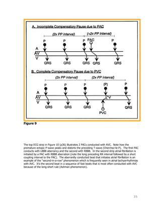 35
Figure 9
The top ECG strip in Figure 10 (p36) illustrates 2 PACs conducted with AVC. Note how the
premature ectopic P-wave peaks and distorts the preceding T-wave (Cherchez-le-P). The first PAC
conducts with LBBB aberrancy and the second with RBBB. In the second strip atrial fibrillation is
initiated by a PAC with RBBB aberration (note the long preceding RR interval followed by a short
coupling interval to the PAC). The aberrantly conducted beat that initiates atrial fibrillation is an
example of the “second-in-a-row” phenomenon which is frequently seen in atrial tachyarrhythmias
with AVC. It‟s the second beat in a sequence of fast beats that is most often conducted with AVC
because of the long-short rule (Ashman phenomenon).
 