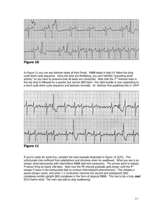 36
Figure 10
In Figure 11 you can see Ashman beats at their finest. RBBB beats in lead V1 follow the long
cycle-short cycle sequence. Since the atria are fibrillating, you can‟t identify “preceding atrial
activity” so you have to presume that all beats are conducted. Note that the 2nd
Ashman beat in
the top strip is followed by a quicker but narrow QRS beat – the right bundle is now responding to
a short cycle-short cycle sequence and behaves normally. Dr. Ashman first published this in 1947!
Figure 11
If you‟re ready for some fun, consider the next example illustrated in Figure 12 (p37). This
unfortunate man suffered from palpitations and dizziness when he swallowed. What you see is an
ectopic atrial tachycardia with intermittent RBBB aberrant conduction. The arrows point to ectopic
P-waves firing at nearly 200 bpm. Note how the PR interval gradually gets longer until the 4th
ectopic P-wave in the tachycardia fails to conduct (Wenckebach phenomenon). This initiates a
pause (longer cycle), and when 1:1 conduction resumes the second and subsequent QRS
complexes exhibit upright QRS complexes in the form of atypical RBBB. This has to be a truly cool
ECG rhythm strip! The man was told to stop swallowing!
 