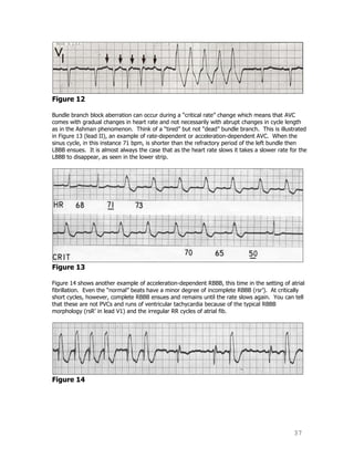 37
Figure 12
Bundle branch block aberration can occur during a “critical rate” change which means that AVC
comes with gradual changes in heart rate and not necessarily with abrupt changes in cycle length
as in the Ashman phenomenon. Think of a “tired” but not “dead” bundle branch. This is illustrated
in Figure 13 (lead II), an example of rate-dependent or acceleration-dependent AVC. When the
sinus cycle, in this instance 71 bpm, is shorter than the refractory period of the left bundle then
LBBB ensues. It is almost always the case that as the heart rate slows it takes a slower rate for the
LBBB to disappear, as seen in the lower strip.
Figure 13
Figure 14 shows another example of acceleration-dependent RBBB, this time in the setting of atrial
fibrillation. Even the “normal” beats have a minor degree of incomplete RBBB (rsr‟). At critically
short cycles, however, complete RBBB ensues and remains until the rate slows again. You can tell
that these are not PVCs and runs of ventricular tachycardia because of the typical RBBB
morphology (rsR‟ in lead V1) and the irregular RR cycles of atrial fib.
Figure 14
 