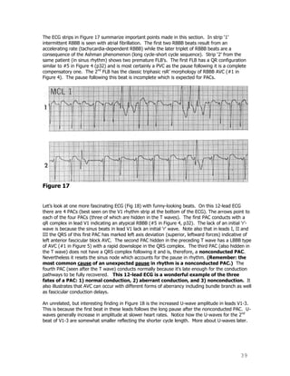 39
The ECG strips in Figure 17 summarize important points made in this section. In strip „1‟
intermittent RBBB is seen with atrial fibrillation. The first two RBBB beats result from an
accelerating rate (tachycardia-dependent RBBB) while the later triplet of RBBB beats are a
consequence of the Ashman phenomenon (long cycle-short cycle sequence). Strip „2‟ from the
same patient (in sinus rhythm) shows two premature FLB‟s. The first FLB has a QR configuration
similar to #5 in Figure 4 (p32) and is most certainly a PVC as the pause following it is a complete
compensatory one. The 2nd
FLB has the classic triphasic rsR‟ morphology of RBBB AVC (#1 in
Figure 4). The pause following this beat is incomplete which is expected for PACs.
Figure 17
Let‟s look at one more fascinating ECG (Fig 18) with funny-looking beats. On this 12-lead ECG
there are 4 PACs (best seen on the V1 rhythm strip at the bottom of the ECG). The arrows point to
each of the four PACs (three of which are hidden in the T waves). The first PAC conducts with a
qR complex in lead V1 indicating an atypical RBBB (#5 in Figure 4, p32). The lack of an initial „r‟-
wave is because the sinus beats in lead V1 lack an initial „r‟ wave. Note also that in leads I, II and
III the QRS of this first PAC has marked left axis deviation (superior, leftward forces) indicative of
left anterior fascicular block AVC. The second PAC hidden in the preceding T wave has a LBBB type
of AVC (#1 in Figure 5) with a rapid downslope in the QRS complex. The third PAC (also hidden in
the T wave) does not have a QRS complex following it and is, therefore, a nonconducted PAC.
Nevertheless it resets the sinus node which accounts for the pause in rhythm. (Remember: the
most common cause of an unexpected pause in rhythm is a nonconducted PAC.) The
fourth PAC (seen after the T wave) conducts normally because it‟s late enough for the conduction
pathways to be fully recovered. This 12-lead ECG is a wonderful example of the three
fates of a PAC: 1) normal conduction, 2) aberrant conduction, and 3) nonconduction. It
also illustrates that AVC can occur with different forms of aberrancy including bundle branch as well
as fascicular conduction delays.
An unrelated, but interesting finding in Figure 18 is the increased U-wave amplitude in leads V1-3.
This is because the first beat in these leads follows the long pause after the nonconducted PAC. U-
waves generally increase in amplitude at slower heart rates. Notice how the U-waves for the 2nd
beat of V1-3 are somewhat smaller reflecting the shorter cycle length. More about U-waves later.
 