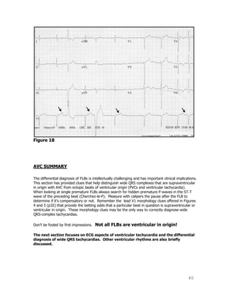 40
Figure 18
AVC SUMMARY
The differential diagnosis of FLBs is intellectually challenging and has important clinical implications.
This section has provided clues that help distinguish wide QRS complexes that are supraventricular
in origin with AVC from ectopic beats of ventricular origin (PVCs and ventricular tachycardia).
When looking at single premature FLBs always search for hidden premature P-waves in the ST-T
wave of the preceding beat (Cherchez-le-P). Measure with calipers the pause after the FLB to
determine if it‟s compensatory or not. Remember the lead V1 morphology clues offered in Figures
4 and 5 (p32) that provide the betting odds that a particular beat in question is supraventricular or
ventricular in origin. These morphology clues may be the only way to correctly diagnose wide
QRS-complex tachycardias.
Don‟t be fooled by first impressions. Not all FLBs are ventricular in origin!
The next section focuses on ECG aspects of ventricular tachycardia and the differential
diagnosis of wide QRS tachycardias. Other ventricular rhythms are also briefly
discussed.
 