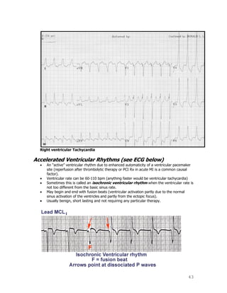 43
Right ventricular Tachycardia
Accelerated Ventricular Rhythms (see ECG below)
An “active” ventricular rhythm due to enhanced automaticity of a ventricular pacemaker
site (reperfusion after thrombolytic therapy or PCI Rx in acute MI is a common causal
factor).
Ventricular rate can be 60-110 bpm (anything faster would be ventricular tachycardia)
Sometimes this is called an isochronic ventricular rhythm when the ventricular rate is
not too different from the basic sinus rate.
May begin and end with fusion beats (ventricular activation partly due to the normal
sinus activation of the ventricles and partly from the ectopic focus).
Usually benign, short lasting and not requiring any particular therapy.
 