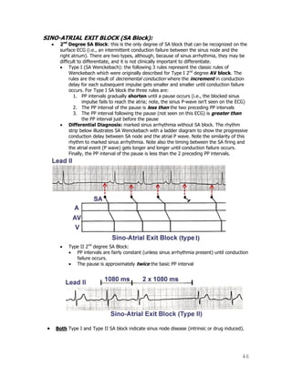 46
SINO-ATRIAL EXIT BLOCK (SA Block):
2nd
Degree SA Block: this is the only degree of SA block that can be recognized on the
surface ECG (i.e., an intermittent conduction failure between the sinus node and the
right atrium). There are two types, although, because of sinus arrhythmia, they may be
difficult to differentiate, and it is not clinically important to differentiate.
Type I (SA Wenckebach): the following 3 rules represent the classic rules of
Wenckebach which were originally described for Type I 2nd
degree AV block. The
rules are the result of decremental conduction where the increment in conduction
delay for each subsequent impulse gets smaller and smaller until conduction failure
occurs. For Type I SA block the three rules are:
1. PP intervals gradually shorten until a pause occurs (i.e., the blocked sinus
impulse fails to reach the atria; note, the sinus P-wave isn‟t seen on the ECG)
2. The PP interval of the pause is less than the two preceding PP intervals
3. The PP interval following the pause (not seen on this ECG) is greater than
the PP interval just before the pause
Differential Diagnosis: marked sinus arrhythmia without SA block. The rhythm
strip below illustrates SA Wenckebach with a ladder diagram to show the progressive
conduction delay between SA node and the atrial P wave. Note the similarity of this
rhythm to marked sinus arrhythmia. Note also the timing between the SA firing and
the atrial event (P wave) gets longer and longer until conduction failure occurs.
Finally, the PP interval of the pause is less than the 2 preceding PP intervals.
Type II 2nd
degree SA Block:
PP intervals are fairly constant (unless sinus arrhythmia present) until conduction
failure occurs.
The pause is approximately twice the basic PP interval
Both Type I and Type II SA block indicate sinus node disease (intrinsic or drug induced).
 