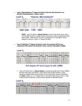 48
Type I (Wenckebach) 2nd
degree AV block (note the RR intervals in ms
duration illustrating the 3 classic rules):
NOTE: Type I AV block is almost always in the AV node itself, which means
that the QRS duration is usually narrow, unless there is also a preexisting bundle
branch block. Note also the 4:3 and 3:2 groupings of P‟s and QRS‟s. Group
beating is common in type I 2nd
degree AV block.
Type II (Mobitz) 2nd
degree AV block: (note: the constant PR for two
consecutive PR's before the blocked P wave, and the wide QRS of LBBB)
Type II AV block there is almost always a preexisting bundle branch block (LBBB in
the ECG strips above and below), which means that the QRS duration is wide
indicating complete block of one bundle The nonconducted P waves are blocked in
the other bundle (i.e., a 2nd
degree block in the right bundle branch). Also, in Type
II block several consecutive P waves may be blocked as illustrated below:
 