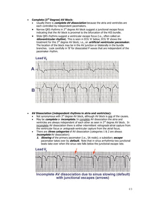 49
Complete (3rd
Degree) AV Block:
Usually there is complete AV dissociation because the atria and ventricles are
each controlled by independent pacemakers.
Narrow QRS rhythms in 3rd
degree AV block suggest a junctional escape focus
indicating that the AV block is proximal to the bifurcation of the HIS bundle.
Wide QRS rhythms suggest a ventricular escape focus (i.e., often called an
idioventricular rhythm). This is seen in ECG 'A' below; ECG 'B' shows the
treatment for this 3rd
degree AV block; i.e., an artificial ventricular pacemaker.
The location of the block may be in the AV junction or bilaterally in the bundle
branches. Look carefully in „B‟ for dissociated P waves that are independent of the
pacemaker rhythm.
AV Dissociation (independent rhythms in atria and ventricles):
Not synonymous with 3rd
degree AV block, although AV block is one of the causes.
May be complete or incomplete. In complete AV dissociation the atria and
ventricles are always independent of each other as seen in 3rd
degree AV block. In
incomplete AV dissociation there is either intermittent retrograde atrial capture from
the ventricular focus or antegrade ventricular capture from the atrial focus.
There are three categories of AV dissociation (categories 1 & 2 are always
incomplete AV dissociation):
1. Slowing of the primary pacemaker (i.e., SA node); a subsidiary escape
pacemaker takes over by default. Note that in sinus arrhythmia two junctional
beats take over when the sinus rate falls below the junctional escape rate.
 