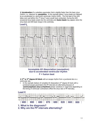50
2. Acceleration of a subsidiary pacemaker that is slightly faster than the basic sinus
rhythm; i.e., takeover by usurpation. In the example below 2 sinus beats are followed
by an accelerated (or isochronic) ventricular rhythm (AVR). The first beat of the AVR
takes over just before the 3rd
sinus P wave would have conducted. During the AVR
occasional sinus beats sneak into the ventricles and fusion beats may appear when the
sinus beat and AVR beat merge in the ventricles.
3. 2nd
or 3rd
degree AV block with an escape rhythm from a junctional site or a
ventricular site:
 In the example (below) of complete AV dissociation (3rd
degree AV bock with a
junctional escape pacemaker) the PP intervals are alternating because of
ventriculophasic sinus arrhythmia (phasic variations in vagal tone depending on
the timing of ventricular contractions effect the sinus rate or PP intervals).
 
