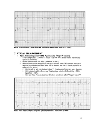 55
WPW Preexcitation (note short PR and delta waves best seen in I, V5-6)
7. ATRIAL ENLARGEMENT
Right Atrial Enlargement (RAE, P-pulmonale, “Viagra P-waves”)
P wave amplitude >2.5 mm in II and/or >1.5 mm in V1 (these criteria are not very
specific or sensitive)
Frontal plane P-wave axis ≥90º (isoelectric in lead I)
Better criteria can be derived from the QRS complex; these QRS changes are due to
both the high incidence of RVH when RAE is present, and the RV displacement by an
enlarged right atrium.
QR, Qr, qR, or qRs morphology in lead V1 (in absence of coronary heart disease)
QRS voltage in V1 is <5 mm and V2/V1 voltage ratio is >6 (Sensitivity = 50%;
Specificity = 90%)
Why are these P waves (see lead II below) sometimes called “Viagra P-waves”?
RAE: note also RAD (+110º) and qR complex in V1 indicative of RVH
 