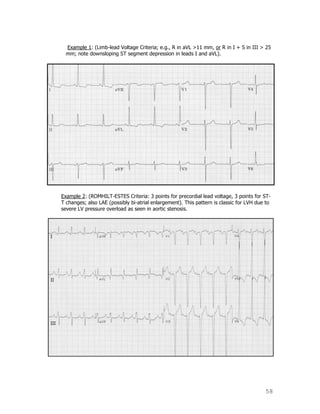 58
Example 1: (Limb-lead Voltage Criteria; e.g., R in aVL >11 mm, or R in I + S in III > 25
mm; note downsloping ST segment depression in leads I and aVL).
Example 2: (ROMHILT-ESTES Criteria: 3 points for precordial lead voltage, 3 points for ST-
T changes; also LAE (possibly bi-atrial enlargement). This pattern is classic for LVH due to
severe LV pressure overload as seen in aortic stenosis.
 