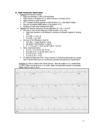 59
II. Right Ventricular Hypertrophy
General ECG features include:
Right axis deviation (>90º) in frontal plane
Tall R-waves in RV leads (V1-2); deep S-waves in LV leads (V5-6)
Slight increase in QRS duration
ST-T changes directed opposite to QRS direction (i.e., wide QRS/T angle)
May see incomplete RBBB pattern or qR pattern in V1
Evidence of right atrial enlargement (RAE)
Specific ECG features (assumes normal calibration of 1 mV = 10 mm):
Any one or more of the following (if QRS duration <0.12 sec):
Right axis deviation (>90 degrees) in presence of disease capable of causing
RVH
R in aVR > 5 mm, or
R in aVR > Q in aVR
Any one of the following in lead V1:
R/S ratio > 1 and negative T wave
qR pattern (see Example #1 below)
R > 7 mm, or S < 2mm, or rSR' with R' >10 mm
Other chest lead criteria:
R in V1 + S in V5 (or V6) 10 mm
R/S ratio in V1 >1 or S/R ratio in V6 >1
R in V5 or V6 < 5 mm
S in V5 or V6 > 7 mm
ST segment depression and T wave inversion in right precordial leads are usually
seen in severe RVH such as in pulmonary stenosis and pulmonary hypertension.
Example #1: RVH in patient with mitral stenosis. Note qR pattern in V1, marked RAD
(+140º), large P-terminal force in V1 (LAE), slight increased QRS duration (incomplete
RBBB), deep S wave in V5-6.
 
