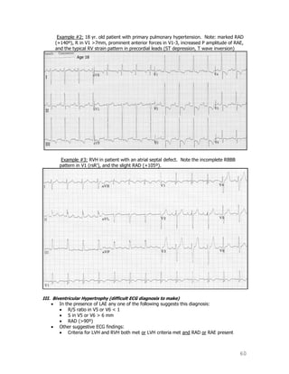 60
Example #2: 18 yr. old patient with primary pulmonary hypertension. Note: marked RAD
(+140º), R in V1 >7mm, prominent anterior forces in V1-3, increased P amplitude of RAE,
and the typical RV strain pattern in precordial leads (ST depression, T wave inversion)
Example #3: RVH in patient with an atrial septal defect. Note the incomplete RBBB
pattern in V1 (rsR‟), and the slight RAD (+105º).
III. Biventricular Hypertrophy (difficult ECG diagnosis to make)
In the presence of LAE any one of the following suggests this diagnosis:
R/S ratio in V5 or V6 < 1
S in V5 or V6 > 6 mm
RAD (>90º)
Other suggestive ECG findings:
Criteria for LVH and RVH both met or LVH criteria met and RAD or RAE present
 