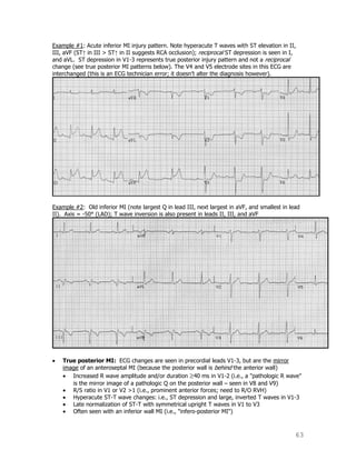 63
Example #1: Acute inferior MI injury pattern. Note hyperacute T waves with ST elevation in II,
III, aVF (ST↑ in III > ST↑ in II suggests RCA occlusion); reciprocal ST depression is seen in I,
and aVL. ST depression in V1-3 represents true posterior injury pattern and not a reciprocal
change (see true posterior MI patterns below). The V4 and V5 electrode sites in this ECG are
interchanged (this is an ECG technician error; it doesn‟t alter the diagnosis however).
Example #2: Old inferior MI (note largest Q in lead III, next largest in aVF, and smallest in lead
II). Axis = -50° (LAD); T wave inversion is also present in leads II, III, and aVF
True posterior MI: ECG changes are seen in precordial leads V1-3, but are the mirror
image of an anteroseptal MI (because the posterior wall is behind the anterior wall)
Increased R wave amplitude and/or duration 40 ms in V1-2 (i.e., a "pathologic R wave"
is the mirror image of a pathologic Q on the posterior wall – seen in V8 and V9)
R/S ratio in V1 or V2 >1 (i.e., prominent anterior forces; need to R/O RVH)
Hyperacute ST-T wave changes: i.e., ST depression and large, inverted T waves in V1-3
Late normalization of ST-T with symmetrical upright T waves in V1 to V3
Often seen with an inferior wall MI (i.e., "infero-posterior MI")
 