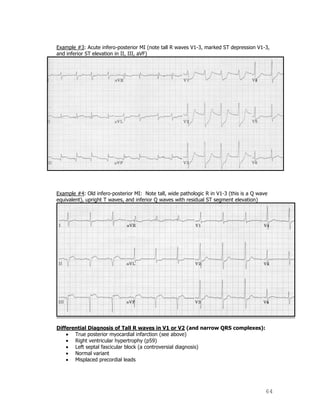 64
Example #3: Acute infero-posterior MI (note tall R waves V1-3, marked ST depression V1-3,
and inferior ST elevation in II, III, aVF)
Example #4: Old infero-posterior MI: Note tall, wide pathologic R in V1-3 (this is a Q wave
equivalent), upright T waves, and inferior Q waves with residual ST segment elevation)
Differential Diagnosis of Tall R waves in V1 or V2 (and narrow QRS complexes):
True posterior myocardial infarction (see above)
Right ventricular hypertrophy (p59)
Left septal fascicular block (a controversial diagnosis)
Normal variant
Misplaced precordial leads
 