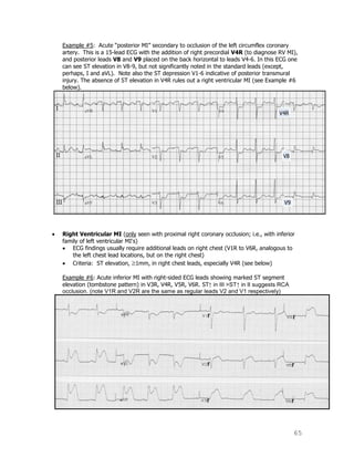 65
Example #5: Acute “posterior MI” secondary to occlusion of the left circumflex coronary
artery. This is a 15-lead ECG with the addition of right precordial V4R (to diagnose RV MI),
and posterior leads V8 and V9 placed on the back horizontal to leads V4-6. In this ECG one
can see ST elevation in V8-9, but not significantly noted in the standard leads (except,
perhaps, I and aVL). Note also the ST depression V1-6 indicative of posterior transmural
injury. The absence of ST elevation in V4R rules out a right ventricular MI (see Example #6
below).
Right Ventricular MI (only seen with proximal right coronary occlusion; i.e., with inferior
family of left ventricular MI's)
ECG findings usually require additional leads on right chest (V1R to V6R, analogous to
the left chest lead locations, but on the right chest)
Criteria: ST elevation, 1mm, in right chest leads, especially V4R (see below)
Example #6: Acute inferior MI with right-sided ECG leads showing marked ST segment
elevation (tombstone pattern) in V3R, V4R, V5R, V6R. ST↑ in III >ST↑ in II suggests RCA
occlusion. (note V1R and V2R are the same as regular leads V2 and V1 respectively)
 