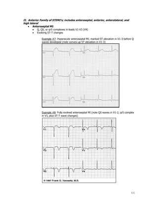 66
II. Anterior Family of STEMI’s; includes anteroseptal, anterior, anterolateral, and
high lateral
Anteroseptal MI
Q, QS, or qrS complexes in leads V1-V3 (V4)
Evolving ST-T changes
Example #7: Hyperacute anteroseptal MI; marked ST elevation in V1-3 before Q
waves developed (note convex-up ST elevation in V1-3)
Example #8: Fully evolved anteroseptal MI (note QS waves in V1-2, qrS complex
in V3, plus ST-T wave changes)
 