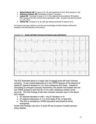 68
Apical-Anterior MI: Q waves in V3, V4, and sometimes in V5-6. No Q waves in I, aVL
Extensive Anterior MI: Combination of above 3 locations.
Lateral MI: Prominent R waves in V1-2 (this replaces the true posterior MI location;
MRI imaging of the left ventricle shows no posterior wall). Q waves may also be present
in I, aVL, V5-6.
Inferor MI: Q waves in II, III, aVF, but without prominent R waves in V1-2
(It remains to be seen whether or not this new terminology of infarct location will become
accepted in the ECG literature of the future)
Example #11: Acute Left Main Coronary Occlusion (pay attention!):
The ECG illustrated above is a tragic case of missed acute left main coronary
occlusion. It was missed diagnosed as a non-STEMI because of the absence of
typical ST segment elevation in 2 or more contiguous ECG leads. Instead of
proceeding to emergent coronary intervention, the patient was treated with the
non-STEMI protocol in the CCU for 12 hrs until a disastrous cardiac arrest
occurred. The ECG findings of left main coronary occlusion seen in the above
ECG include:
ST segment elevation in aVR > any ST elevation in V1
ST segment depression in 7 or more leads of the 12-lead ECG
This ECG is considered a STEMI equivalent and should be Rx‟ed
emergently.
Similar ECG findings may occur in acute MI due to severe 3-vessel coronary
artery disease.
 
