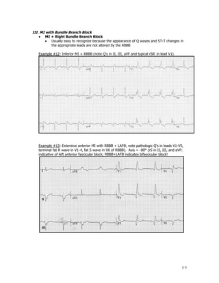 69
III. MI with Bundle Branch Block
MI + Right Bundle Branch Block
Usually easy to recognize because the appearance of Q waves and ST-T changes in
the appropriate leads are not altered by the RBBB
Example #12: Inferior MI + RBBB (note Q's in II, III, aVF and typical rSR' in lead V1)
Example #13: Extensive anterior MI with RBBB + LAFB; note pathologic Q's in leads V1-V5,
terminal fat R wave in V1-4, fat S wave in V6 of RBBB). Axis = -80° (rS in II, III, and aVF:
indicative of left anterior fascicular block; RBBB+LAFB indicates bifascicular block!
 