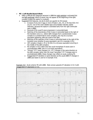 70
MI + Left Bundle Branch Block
Often a difficult ECG diagnosis because in LBBB the right ventricle is activated first
and left ventricular infarct Q waves may not appear at the beginning of the QRS
complex (unless the septum is involved).
Suggested ECG features, not all of which are specific for MI include:
Q waves of any size in two or more of leads I, aVL, V5, or V6 (See ECG #15
on p71: one of the most reliable signs and probably indicates septal
infarction, because the septum is activated early from the right ventricular
side in LBBB)
Reversal of the usual R wave progression in precordial leads
Notching of the downstroke of the S wave in precordial leads to the right of
the transition zone (i.e., before QRS changes from a predominate S wave
complex to a predominate R wave complex); this may be a Q-wave
equivalent appearing after the onset of the QRS.
Notching of the upstroke of the S wave in precordial leads to the right of the
transition zone (another Q-wave equivalent; see V4 in example #15)).
rSR' complex in leads I, V5 or V6 (the S is a Q-wave equivalent occurring in
the middle of the QRS complex)
RS complex in V5-6 rather than the usual monophasic R waves seen in
uncomplicated LBBB; (the S is a Q-wave equivalent).
"Primary" ST-T wave changes (i.e., ST-T changes in the same direction as
the QRS complex rather than the usual "secondary" ST-T changes seen in
uncomplicated LBBB); these changes may reflect an acute, evolving MI.
Exaggerated ST deviation in same direction as the usual LBBB ST changes in
LBBB (see leads V1 and V2 in Example #14)
Example #14: Acute anterior MI with LBBB. Note convex-upwards ST elevation in V1-3 with
exaggerated ST depression in V-6.
 