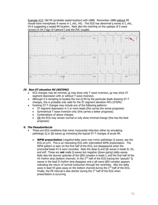 71
Example #15: Old MI (probable septal location) with LBBB. Remember LBBB without MI
should have monophasic R waves in I, aVL, V6). This ECG has abnormal q waves in I, aVL,
V5-6 suggesting a septal MI location. Note also the notching on the upslope of S wave
(arrow) in V4 (“sign of Cabrera”) and the PVC couplet.
IV. Non-ST elevation MI (NSTEMI)
ECG changes may be minimal, or may show only T wave inversion, or may show ST
segment depression with or without T wave inversion.
Although it is tempting to localize the non-Q MI by the particular leads showing ST-T
changes, this is probably only valid for the ST segment elevation MI‟s (STEMI)
Evolving ST-T changes may include any of the following patterns:
ST segment depression in 2 or more leads (this carries the worse prognosis)
Symmetrical T wave inversion only (this carries a better prognosis)
Combinations of above changes
OR the ECG may remain normal or only show minimal change (this has the best
prognosis)
V. The Pseudoinfarcts
These are ECG conditions that mimic myocardial infarction either by simulating
pathologic Q or QS waves or mimicking the typical ST-T changes of acute MI.
WPW preexcitation (negative delta wave may mimic pathologic Q waves; see the
ECG on p72. This is an interesting ECG with intermittent WPW preexcitation. The
WPW pattern is seen on the first half of the ECG, but disappeared when the
precordial leads V1-6 were recorded. Note the deep Q and QS waves in leads II, III,
and aVF. These are not really Q waves but negative (down-going) delta waves.
Note also the slurred upstroke of the QRS complex in leads I, and the first half of the
V5 rhythm strip (bottom channel). In the 2nd
half of the ECG tracing the “pseudo” Q
waves in the lead II rhythm strip disappear and a qR wave QRS complex appears
indicating the return of normal conduction through the ventricles. Also the delta
wave in lead V5 goes away on the bottom channel during the 2nd
half of the ECG.
Finally, the PR interval is also shorter during the 1st
half of the ECG when
preexcitation is occurring.
 